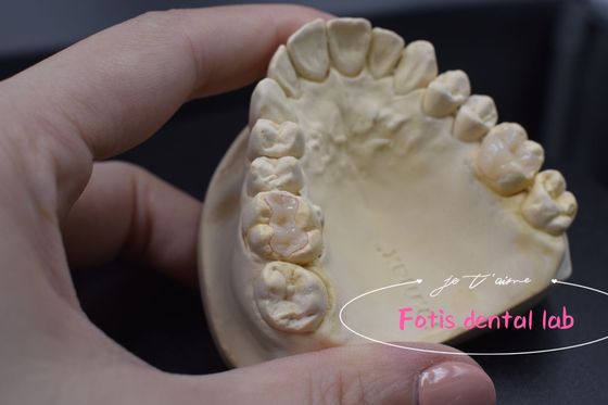 E.Max موثر / Inlays ترکیبی و Onlays برای تعمیر دندان های آسیب دیده یا پوسیده