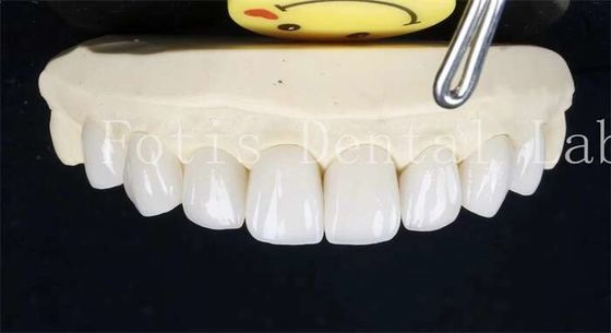 0.3-0.5mm دندان های لامینات سرامیکی دندان های جعلی فنیرها با چسب چسب