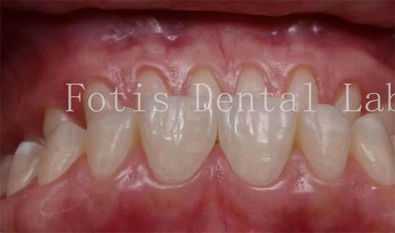 بسته بندی شده به نظر می رسد طبیعی Snap On Veneers 0.3mm-0.5mm ضخامت