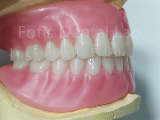 دندانهای ایوکلار پروتز کامل آکریلیک آسان برای تمیز کردن دوام بالا