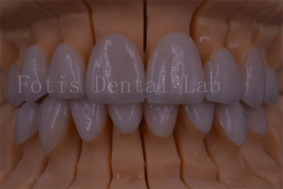 FDA/ISO/CE گواهی شده تاج دیجیتال دندان تاج مصنوعی هر اندازه