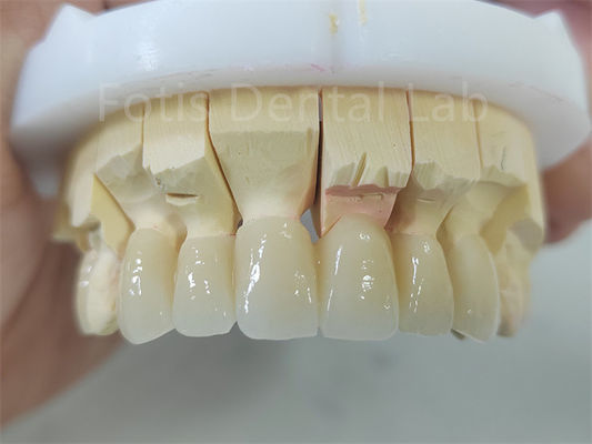 محصولات دندانپزشکی زرکونیا لایه دار با پورسلین نگهداری آسان