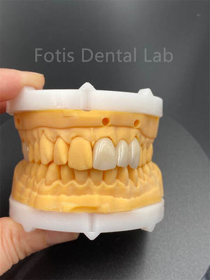سرامیک دندانپزشکی زرکونیا چند لایه ای با دوام بالا برای محصولات پزشکی آزمایشگاه دندانپزشکی