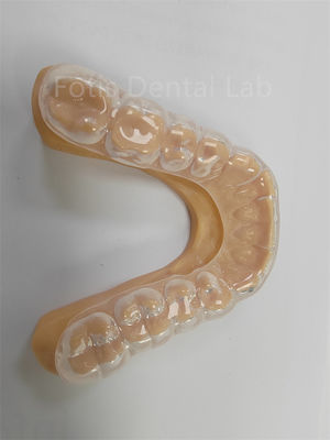Ergonomic سخت نرم Occlusal محافظ نرم دندان محافظ استفاده طولانی مدت