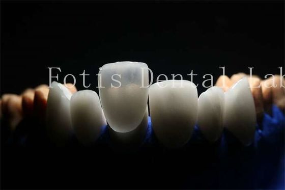 فنیرهای لمینت مصنوعی با مواد پورسلین با دوام طولانی و پایدار