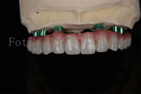جراحی ایمپلنت Zirconia All-on-4 همان روز بهبود حداقل پیگیری مورد نیاز